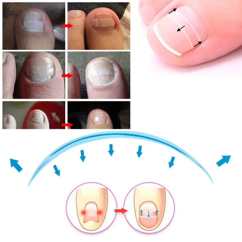 

10Pcs Ingrown Toenails Treatment Straightening Tape Curved Clip Brace Patch Nail Wedge Paronychia Lifter Recover Tape