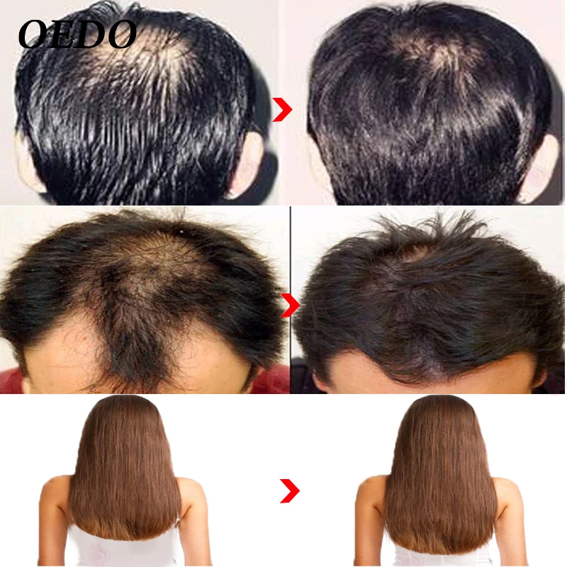 Уход за волосами эссенция лечение выпадения волос ремонт волосяного фолликула уменьшение секущихся кончиков лечение для выпадения волос Быстрый мощный травяной