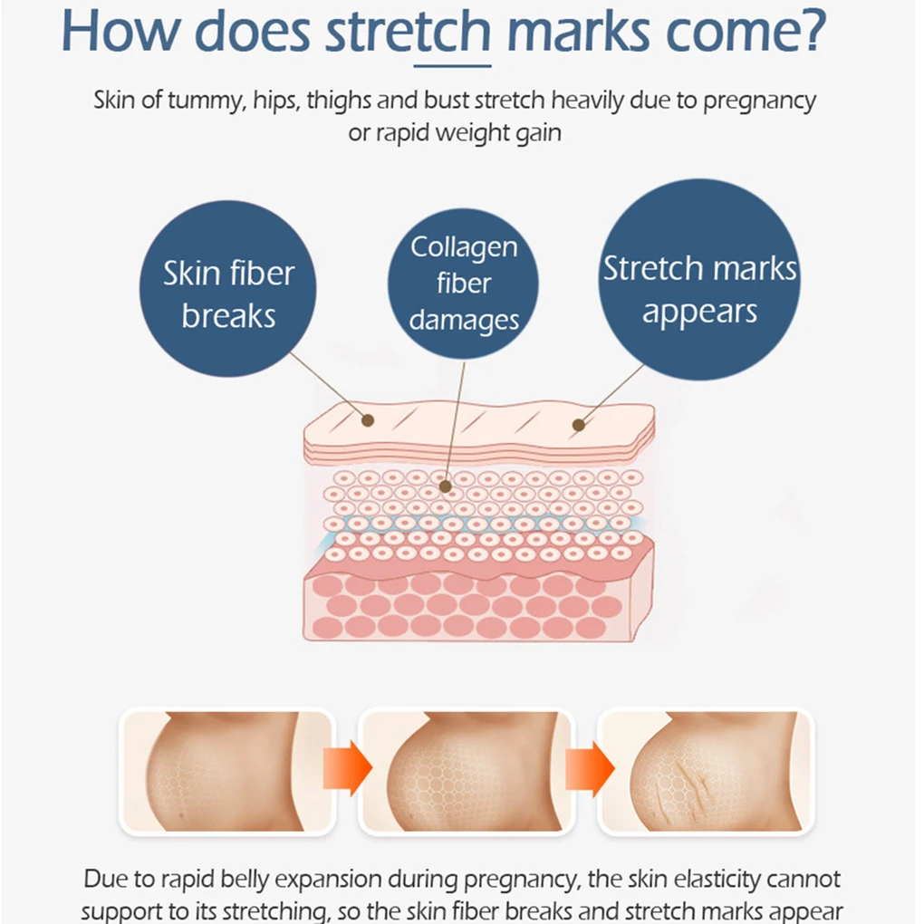 Яркий гламурный мягкий нераздражающий крем для удаления шрамов растягивающийся знак для беременных мазь для лечения шрамов живота Гладкий крем для кожи