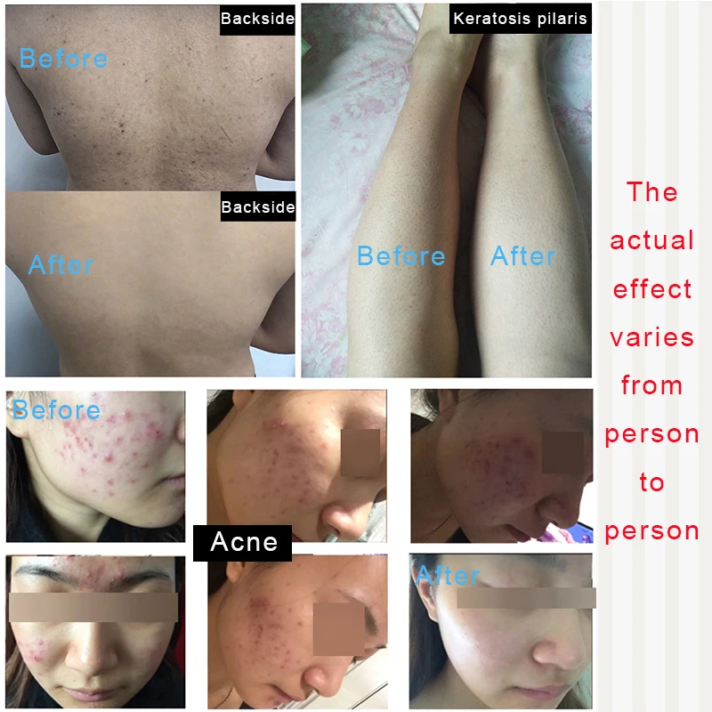 Tanie Kwas glikolowy 40% obieraczka do skóry urządzenie do usuwania trądziku bady Exfoliator zatkane pory skóra bez blasku tkaniny zmarszczki serum trądzik różowaty rośliny trądzik patch