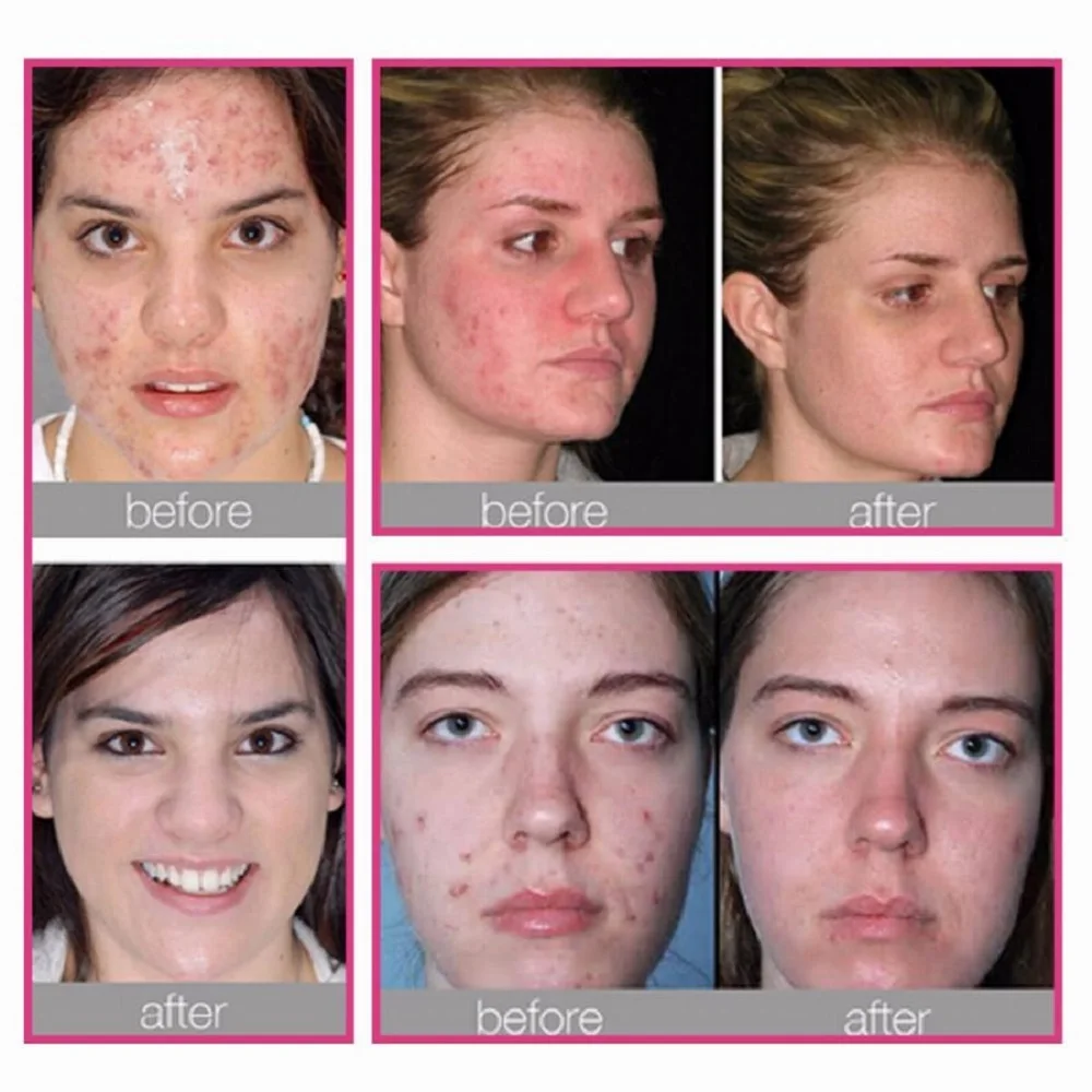 ezgo-pdt-photon-led-facial-mask-skin-rejuvenation-therapy-mask-7-1-model-led-face-mask-in-beauty-instrument