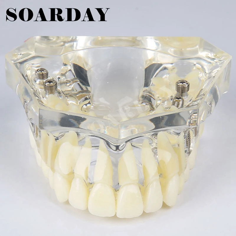 Upper Teeth Implant Dental Model with Bridge for teaching or communicaton (1)