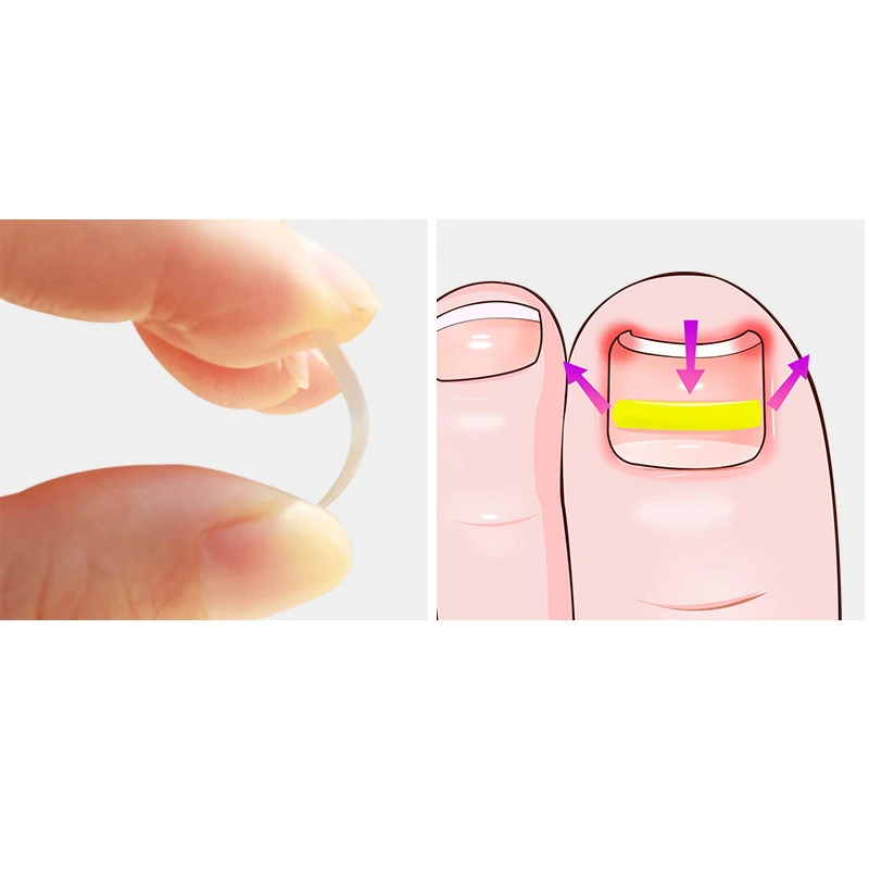 

10pcs/Box Ingrown Toe Nail Correction Sticker Pedicure Transparent Fixer Patches Correction File Corrector Foot Care Tools