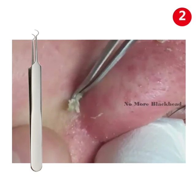 stainless steel Acne Removal Needle From Acne Pimples Pimple Blackhead And Comedone Acne Extractor Remover Acne Needle Treatment