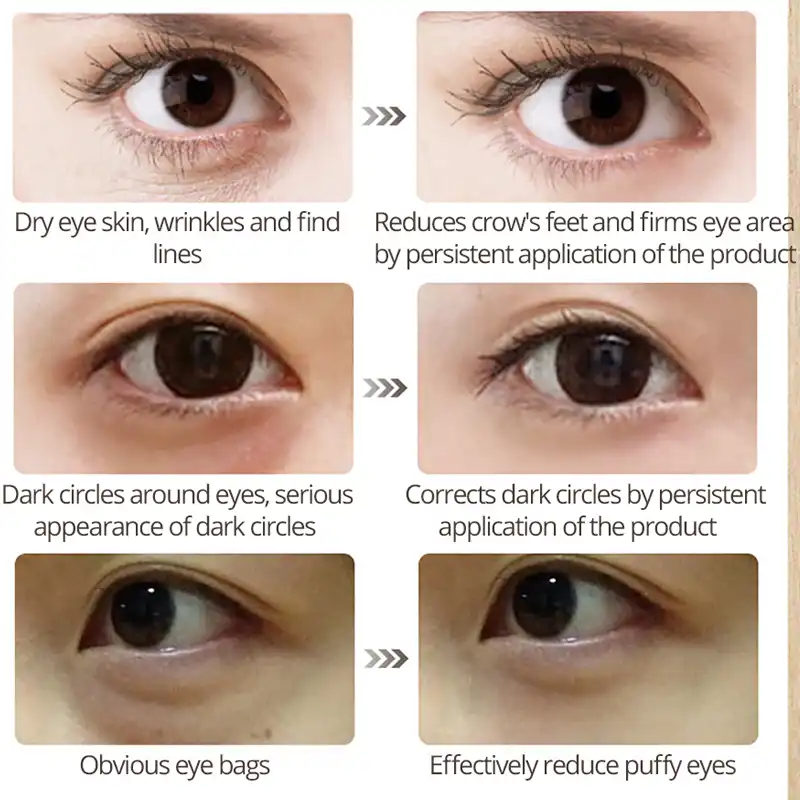 aging skin around eyes