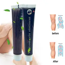 Варикозное расширение вены васкулит лечение фалебит ангиития воспаление кровеносное сосуд язвы на ногах крем против варикозного расширения вен