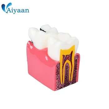 

1 Pc Dental Anatomy Education Teeth Model 6 Times Caries Comparation Study Models For Dentist Studying and Researching