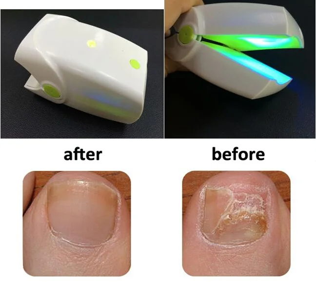 Rechargeable low level laser therapy device lllt no pain Finger Nail Fungus Toe nail disease onychomycosis infections Treatment Rechargeable low level laser therapy device lllt no pain Finger Nail Fungus Toe nail disease onychomycosis infections Treatment