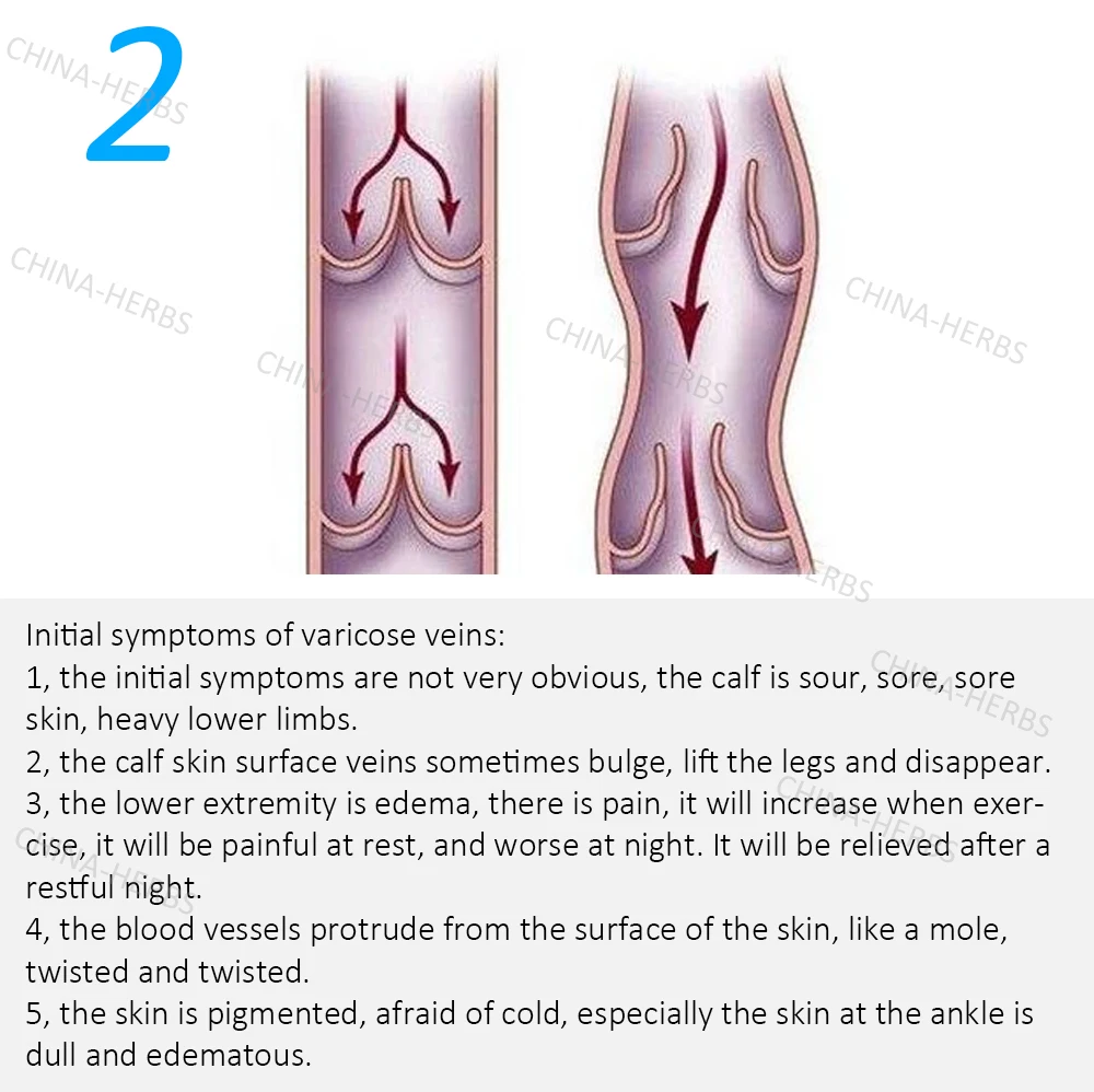 10 шт. варикозное расширение вен болит пластырь к васкулиту ноги кислотные заготовки зуд земляной червь комочки плохая нога травяной ангиит