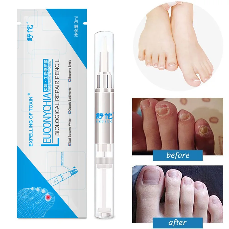 

2018 3ml Nail Fungus Treatment rehydration solution Liquid Anti Fungal Finger Toe Nails Care Restore normal nail Glossy shape