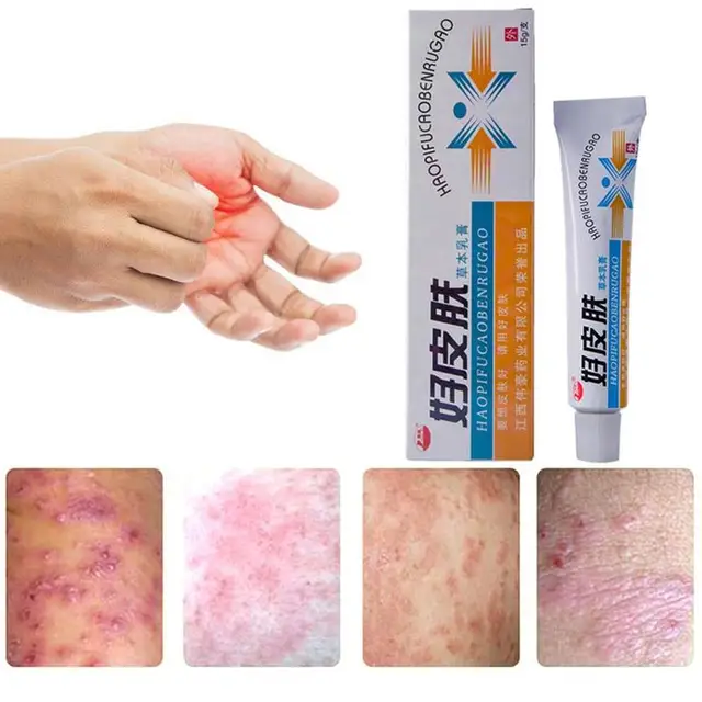 1PCS Skin Psoriasis Cream Dermatitis Eczematoid Eczema Ointment ...