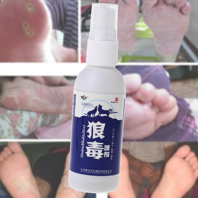 Китайская Кнопка тревожного вызова для псориаз экзема кожи разъедание кожи спрей уход за ногами 60 мл