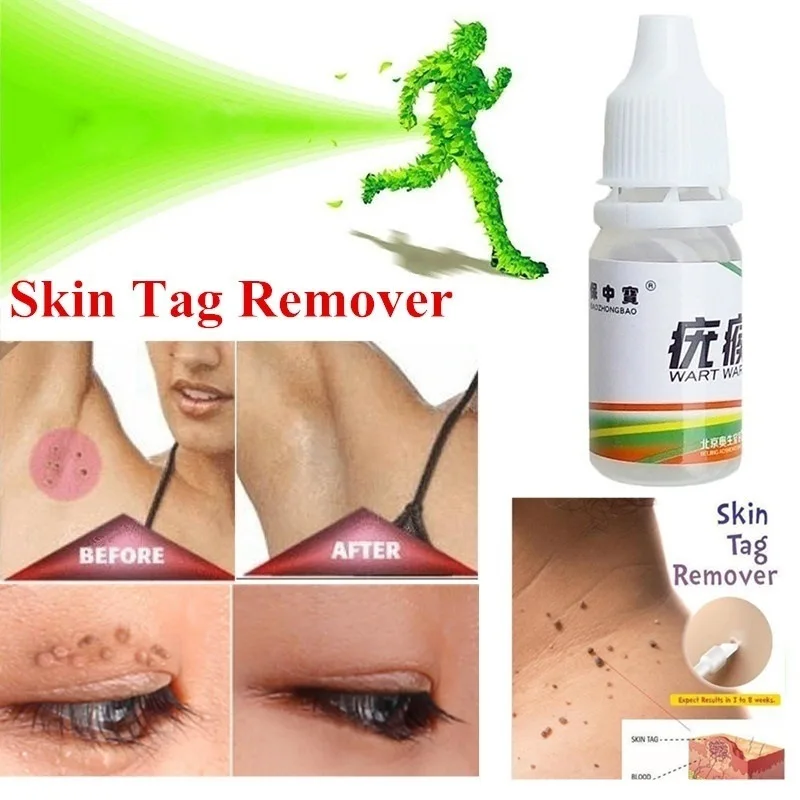

Black Dots Mole Wart Skin Tag Remover 12 Hours Tu Kill Liquid Medical Foot Care Cream Removal Foot Care Mole