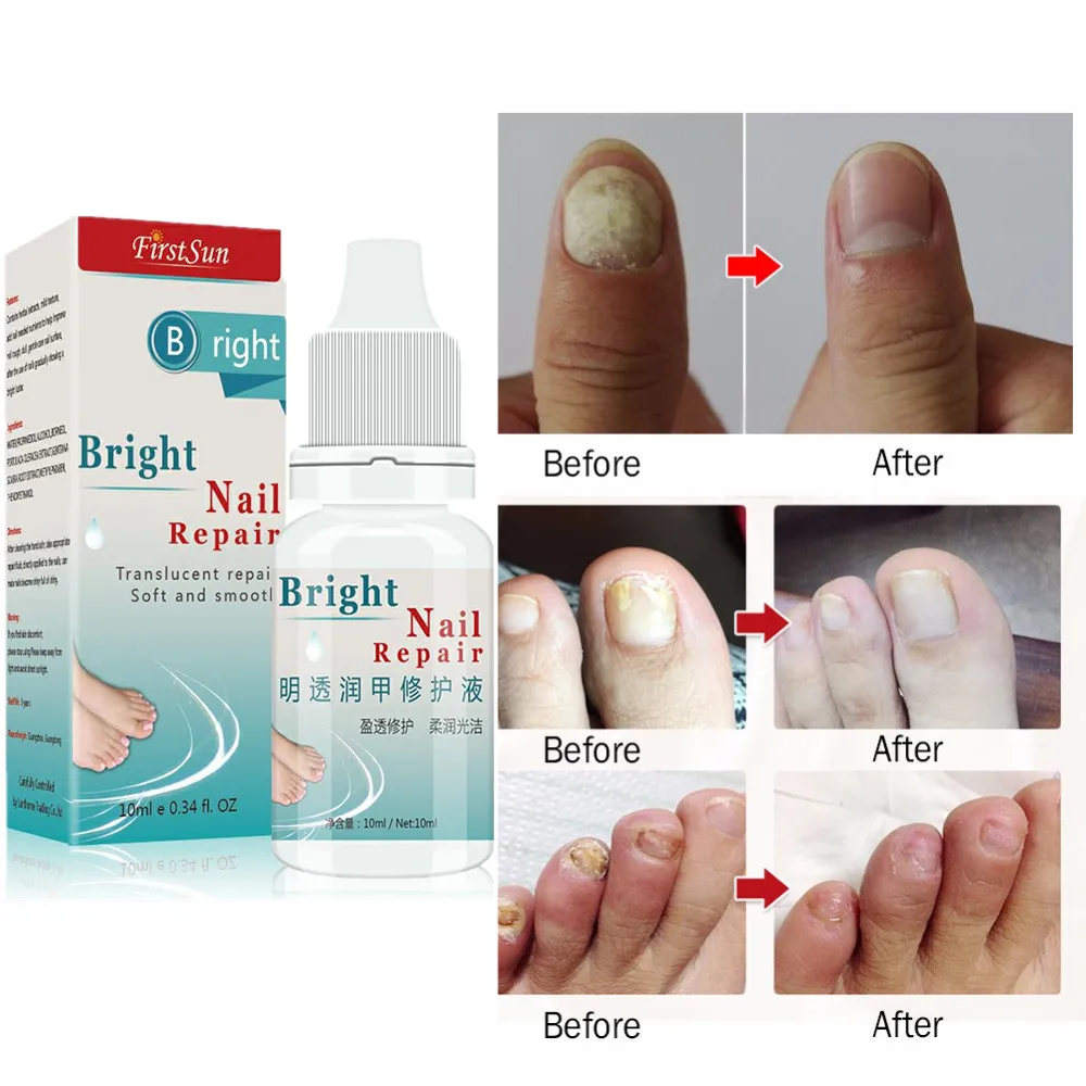 Kills 99.9% Bacteria Nail Care Treatment Nail Fungus Oil Onychomycosis Paronychia Anti Fungal Nail Infection 10ml Repair Nails