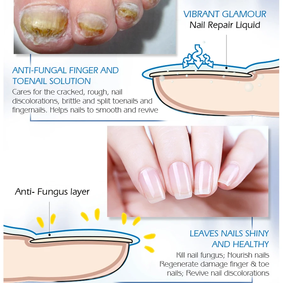 VIBRANT GLAMOUR Nail Repair Serum Nail Treatment Essence Fungus Onychomycosis Removal Anti Fungus Nail Toe Nourishing Nail Care VIBRANT GLAMOUR Nail Repair Serum Nail Treatment Essence Fungus Onychomycosis Removal Anti Fungus Nail Toe Nourishing Nail Care