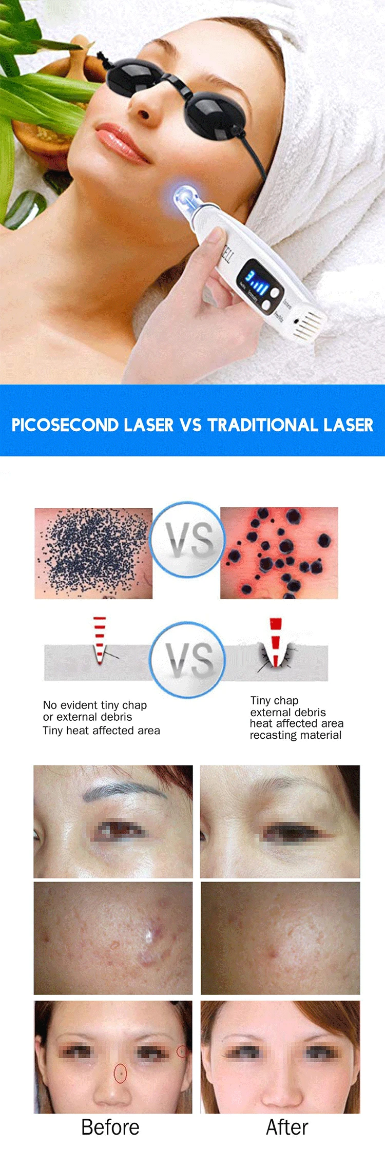 Picosecond-Laser-Pen_07
