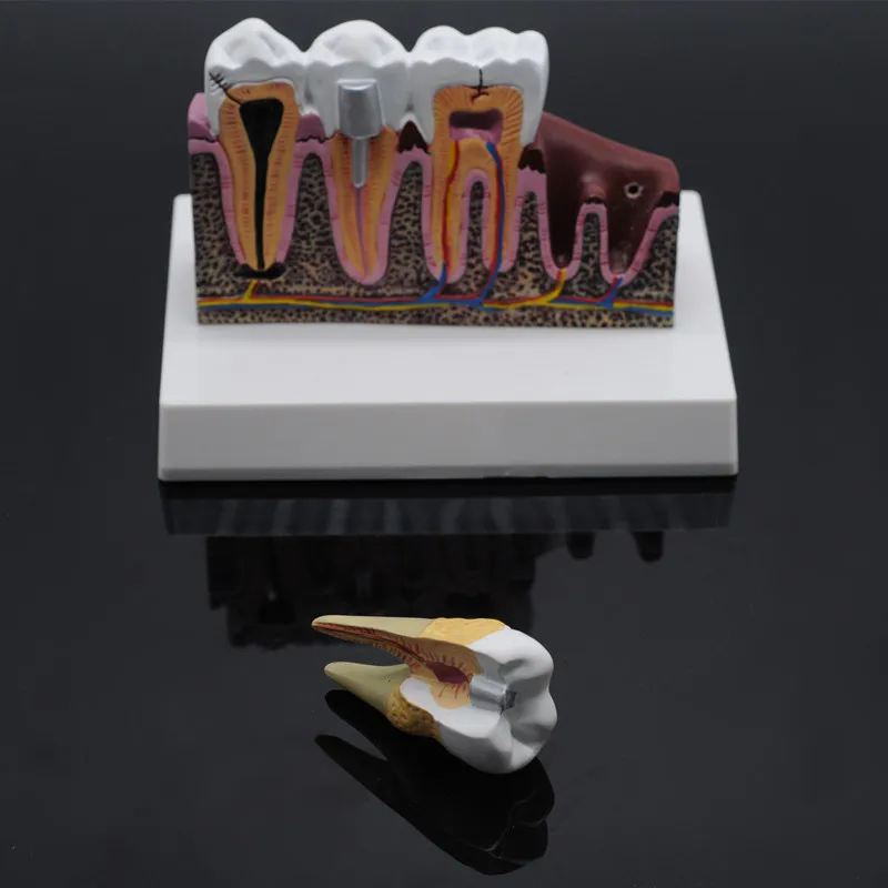 Демонстрация кариеса анатомические зубы общая модель патологий Стоматологическая, съемная