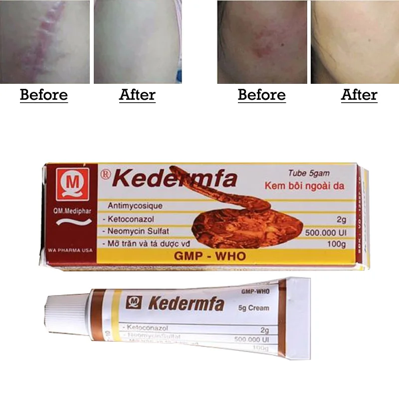 Scar Remover Shrink Pores Gel Acne Scar Strentch Marks Treatment Cream