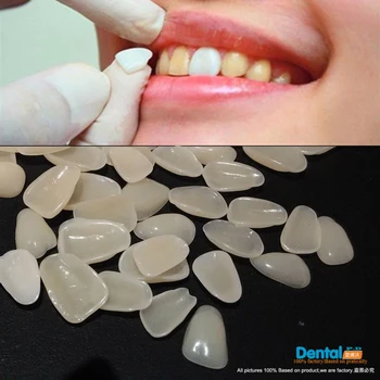 

FREE SHIPPING 100PCS DENTAL WHITENING VENEERS FOR UPPER ANTERIOR TEETH SHADE A1