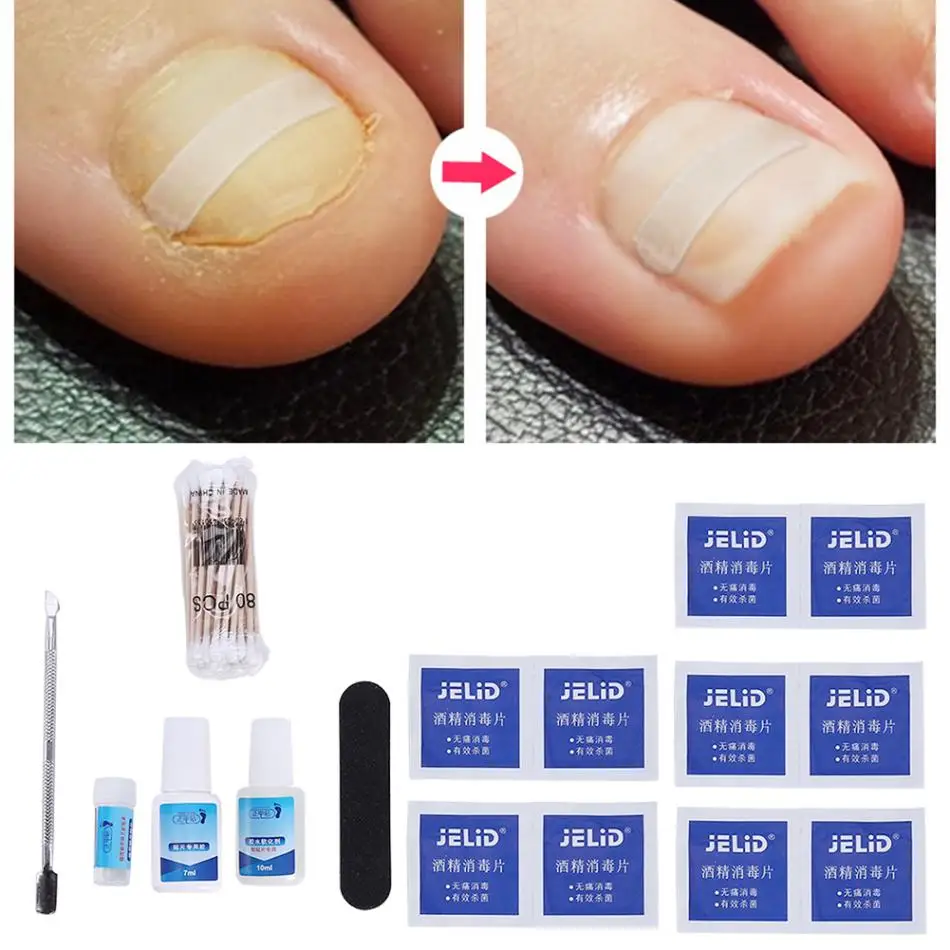 Ingrown Toenail Correction Orthotic Set Toe Nail Straightening Clip