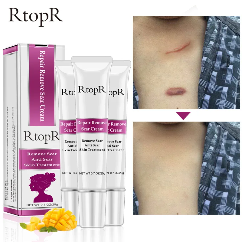 

Acne Scar Stretch Marks Remover Cream Skin Repair Face Cream Acne Spots Acne Treatment Blackhead Whitening Cream Skin Care 3pcs#