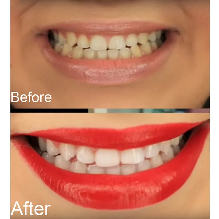 Whitening (4)