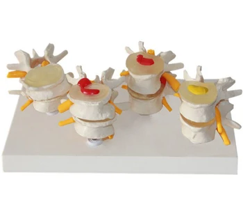 

Humans Skeleton Anatomical 4-stage Osteoporosis Vertebrae Anatomical Model Nursing Model Skin In Trauma Skeleton Spinal Anatomy