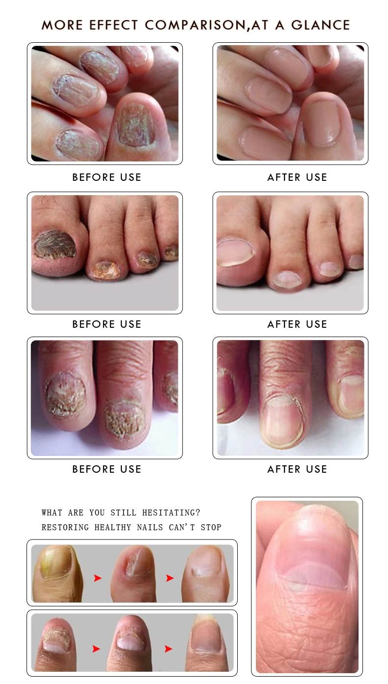 RtopR Лечение ногтей от грибка эссенция для ногтей отбеливающий носок удаление грибка Уход за ногами и ногтями гель для Onychomycosis TSLM2