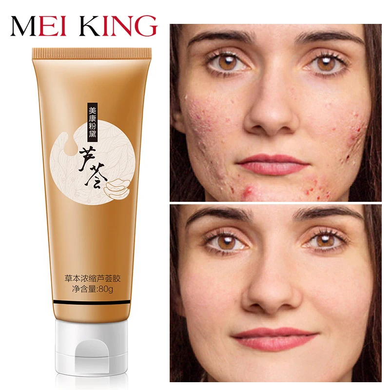 aloe vera for pigmentation