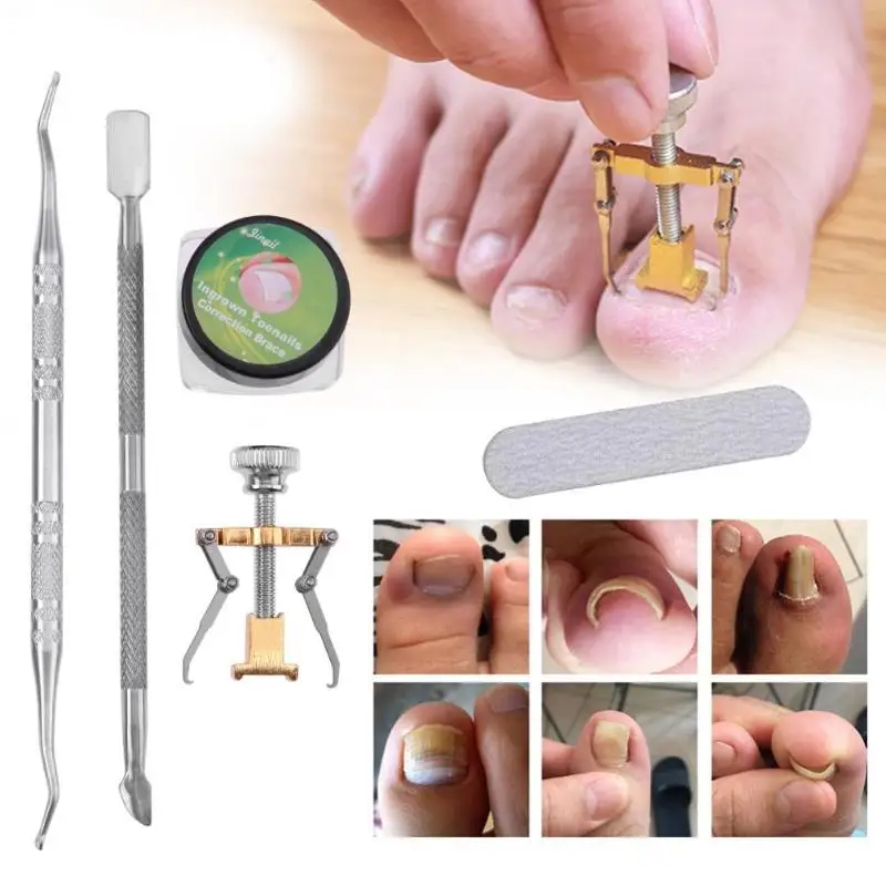 Multi function Ingrown Nail Correction Tools Ingrown Toenail Paronychia
