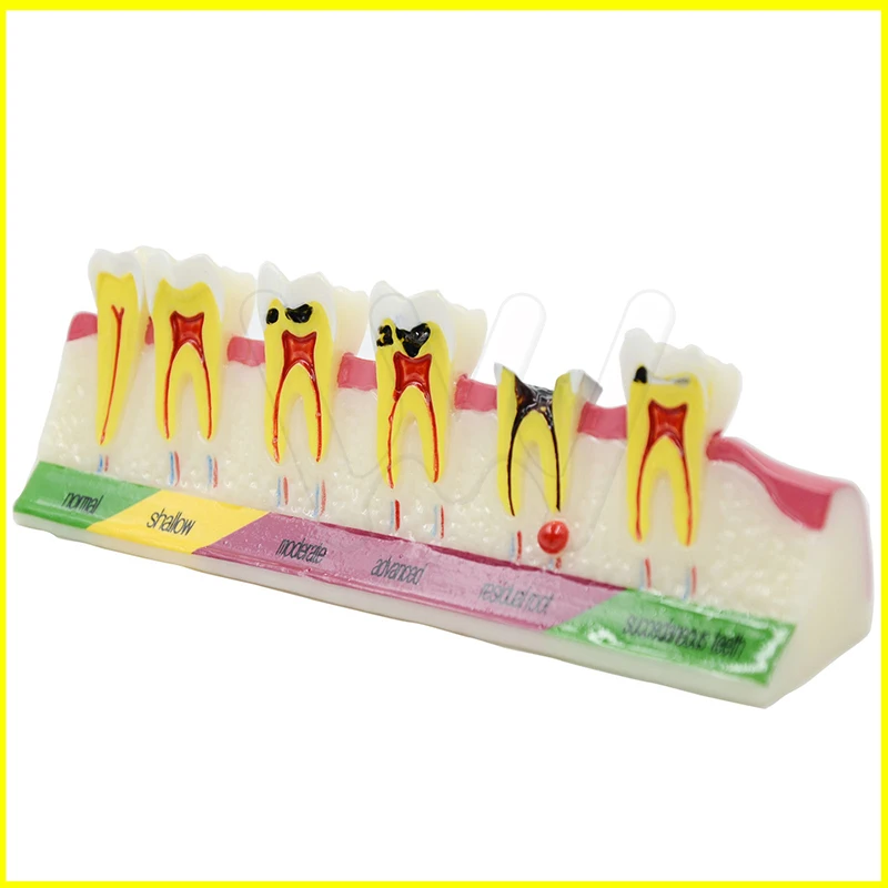 Dental-Caries-Developing-illusteation-Tooth-Model-Demonstration-Teach-_57