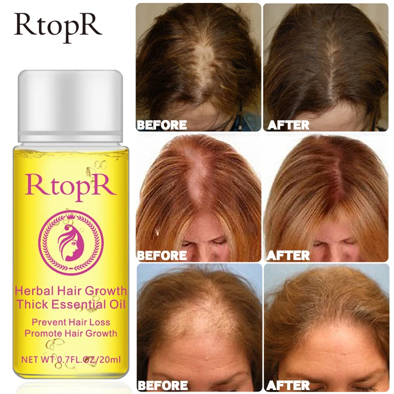 Herbal Hair Growth Anti Hair Loss Liquid Promote Thick Fast Hair Growth Treatment 20ml Essential Oil Health Care Beauty Essence