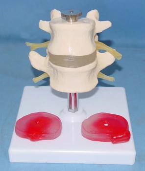 

Two Section of Lumbar Disc Disease Model Umbar Disc Herniation of Intervertebral Disc Disease Model Spine Model