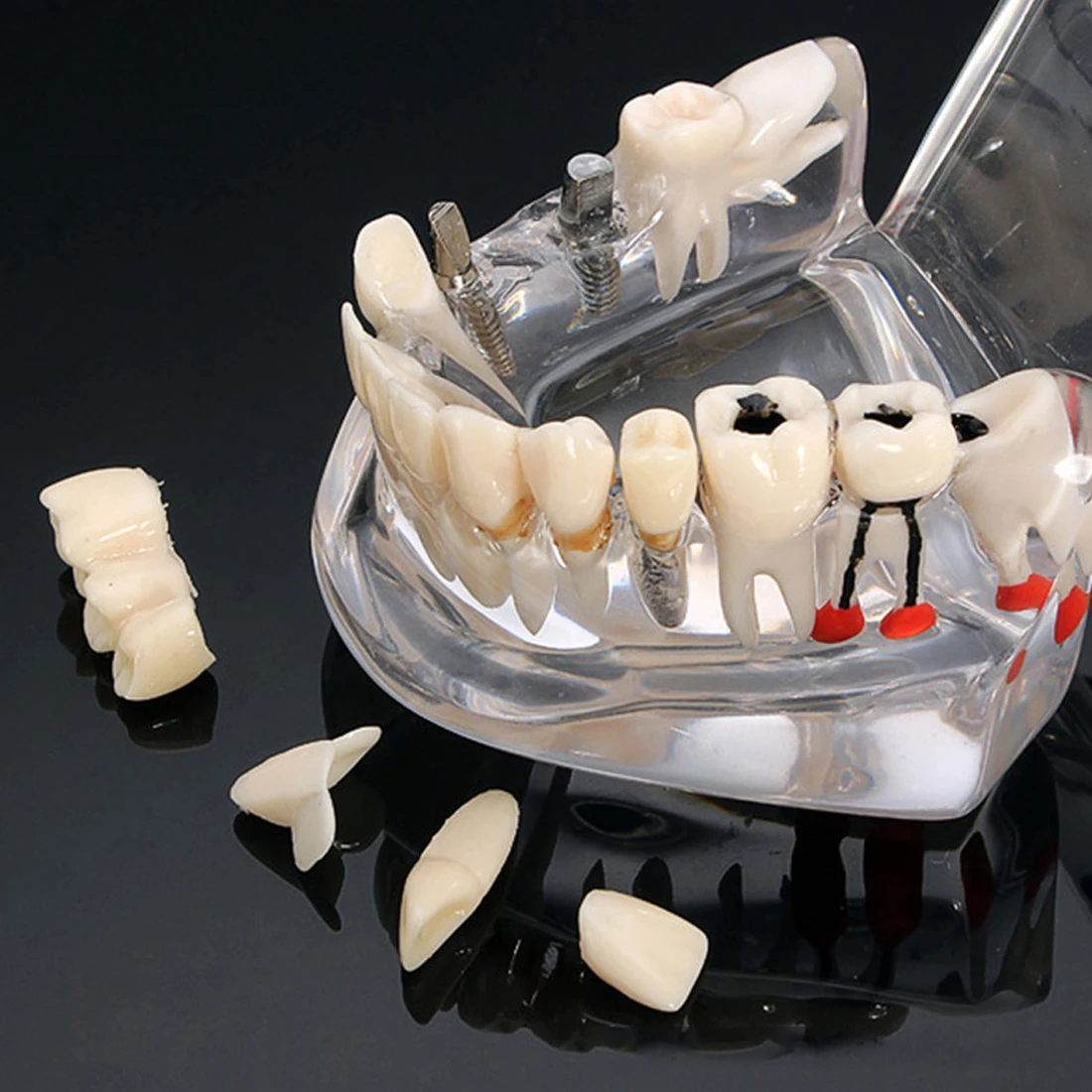 Dental model dental implant model active tooth model pathological tooth