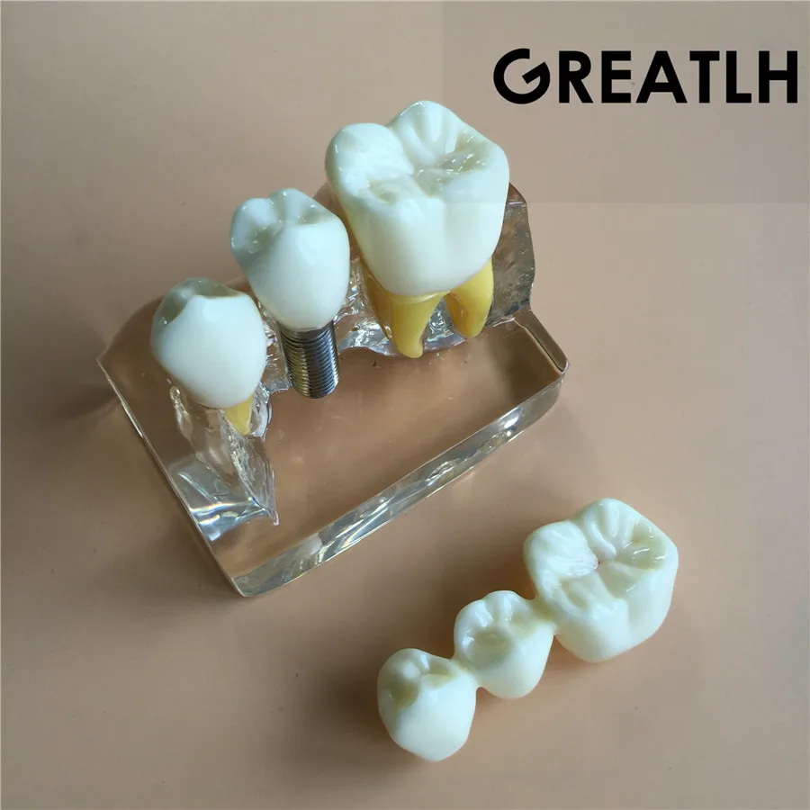 

Clear Dental Demonstration Study Teeth Model for Implant Analysis Crown Bridge Model2017