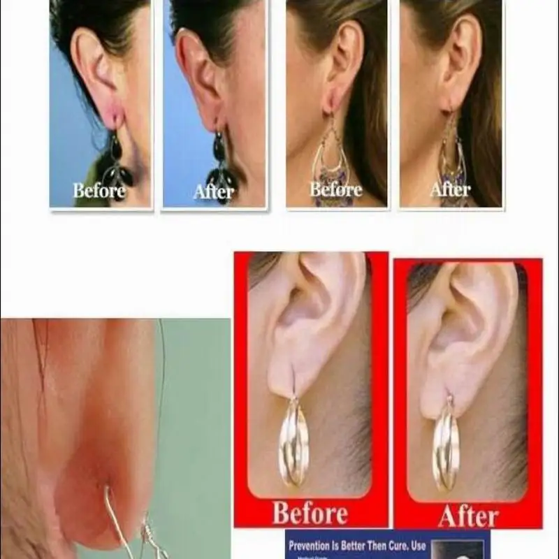 Invisible ear lift patch as Ear Lobe Support Tape for prevent stretched or torn ear lobes protect sticker AS SEEN ON TV.