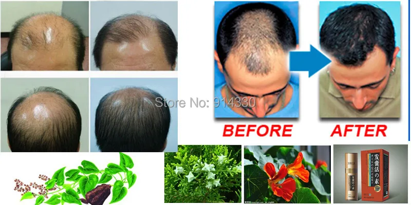 11ml/Pack Boost Hair growth loss uct Hair growth uct ...