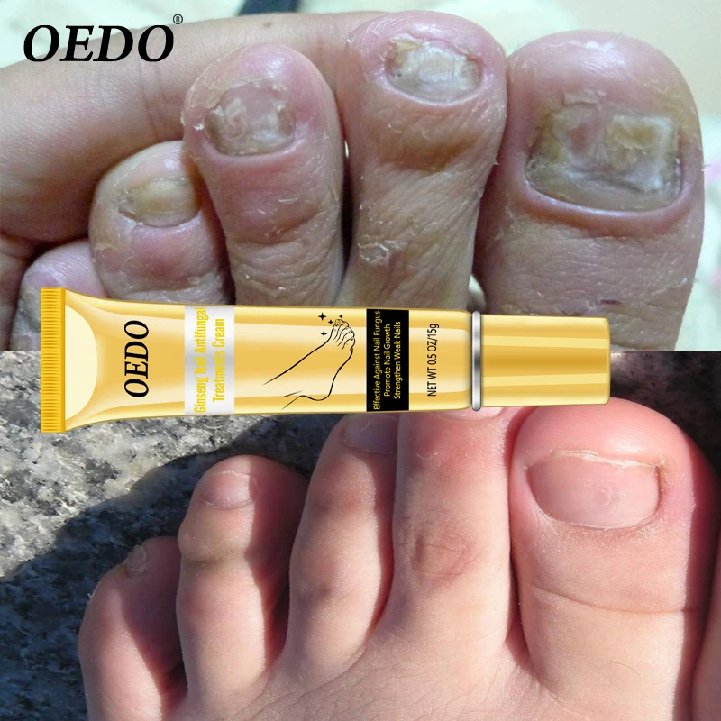 

Ginseng Nail Antifungal Treatments Cream Herbal Removal Nail Fungus Toe Anti Infection Paronychia Onychomycosis Foot Care Cream