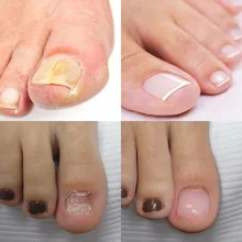 Лечение грибков для ногтей противогрибковый онихомикоз удаление ногтей Уход за ногтями восстанавливающая жидкость 789