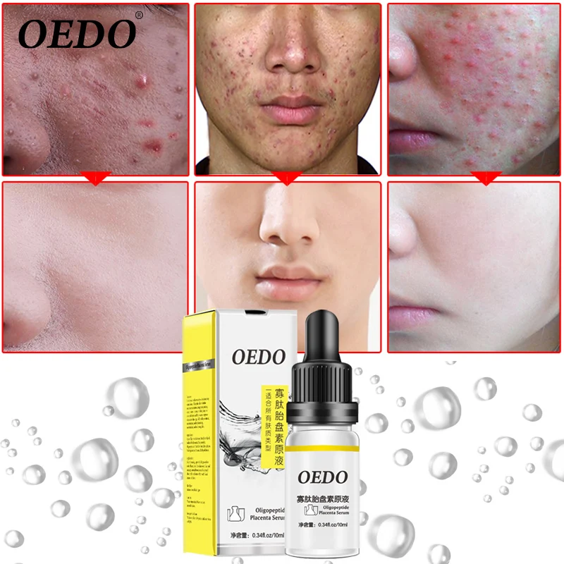 

OEDO Oligopeptide placenta stock solution to remove acne marks acne to reduce scar control oil firming moisturizing facial care