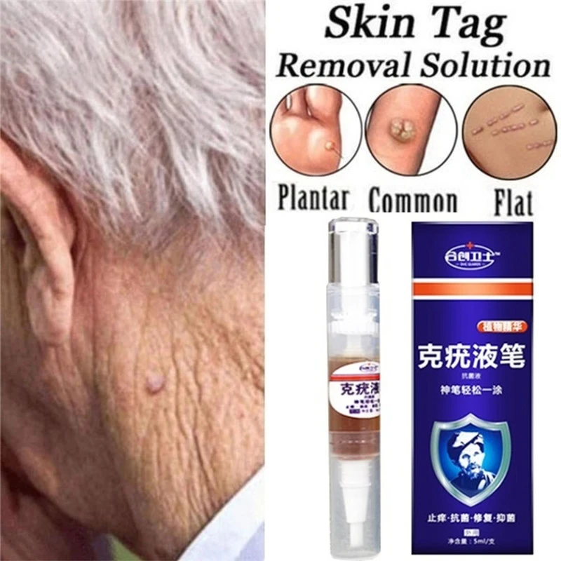 warts treatment cream