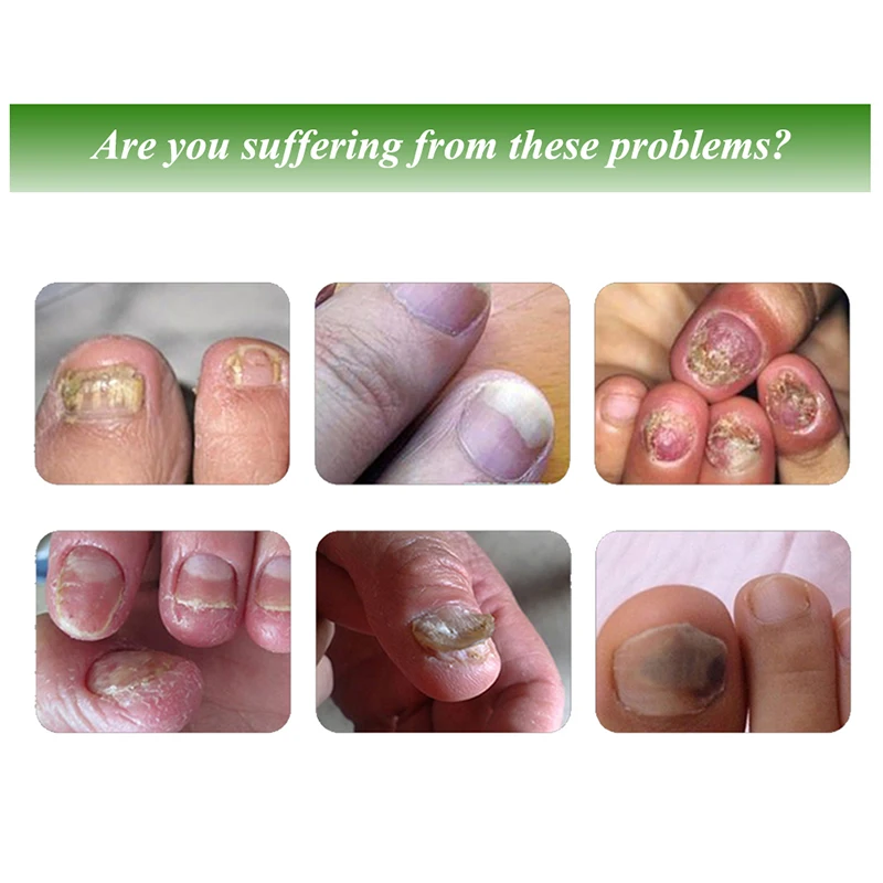 30 мл грибковых ногтей сущность лечения Ногтей Ног отбеливающий грибок ногтей ног Remover Ноги Уход за ногтями гель