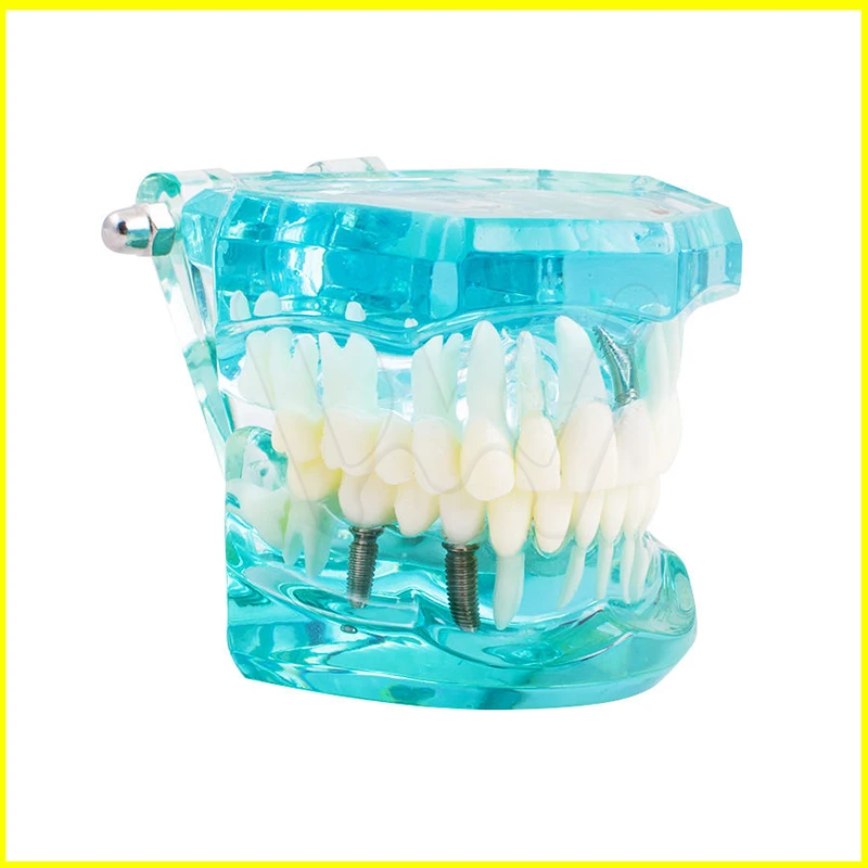 Dental Study Tooth Model Adult Pathological teaching Teeth model new denshine (4)