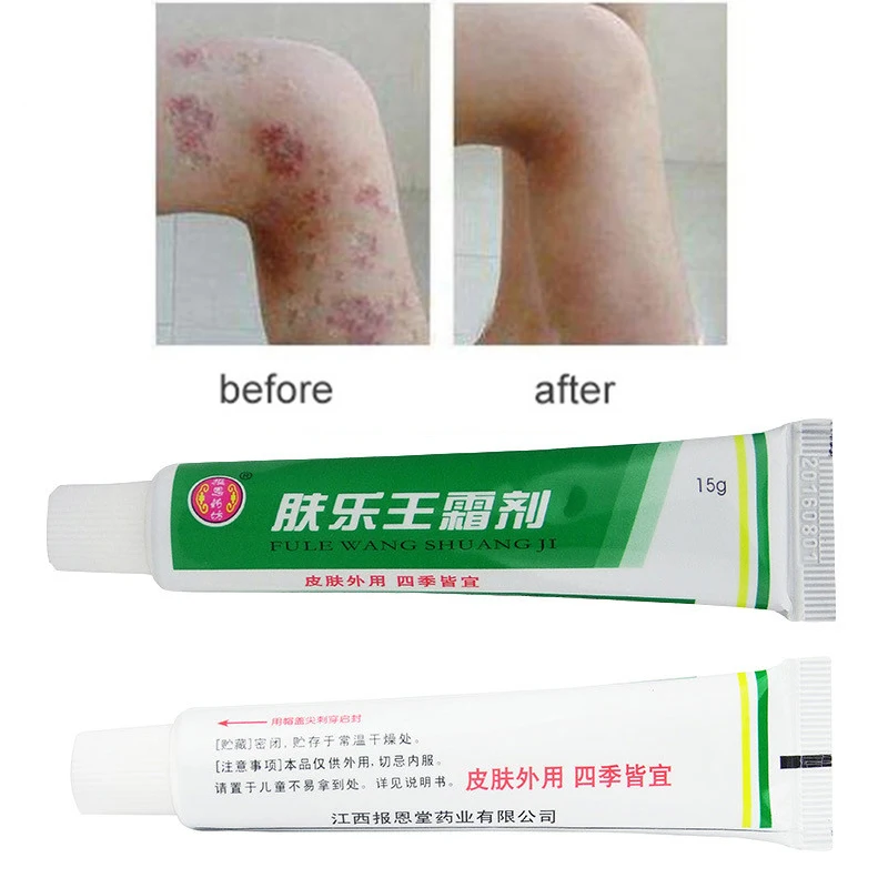 

FULEWANG Skin Psoriasis Cream Plaster Dermatitis Eczematoid Eczema Ointment Treatment Psoriasis Body Lotion Cream 15g