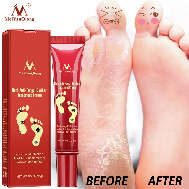Herbal Anti Fungal Relieve Beriberi Foot Cream Treatment Itching , Foot