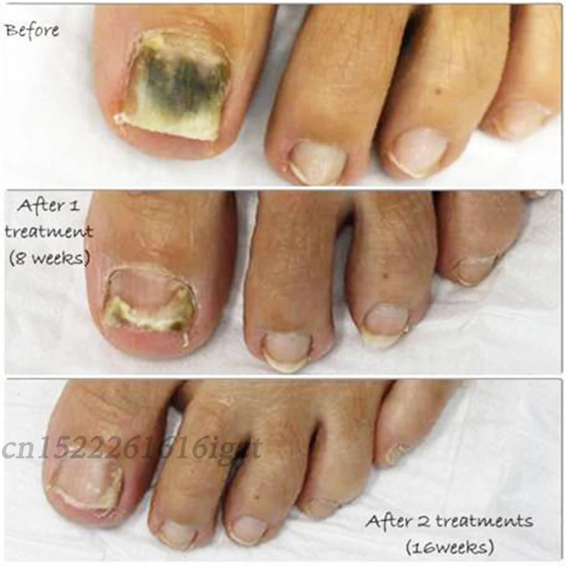 nailfungus_beforeandafter_540x