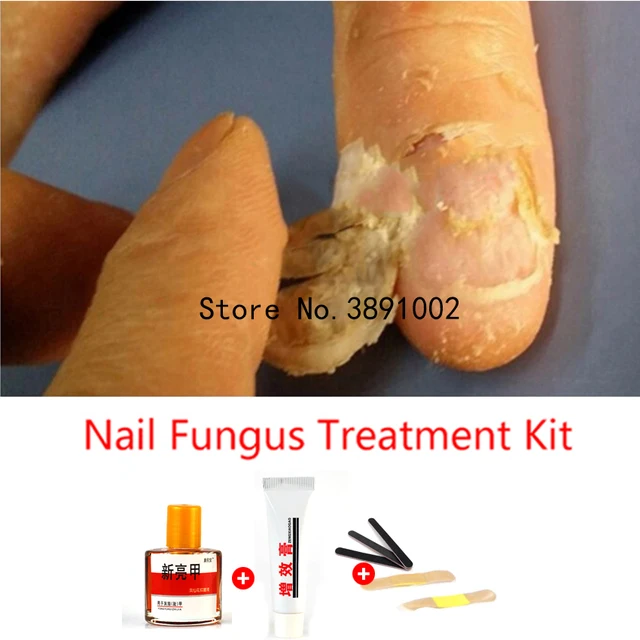 Herbal Fungal Nail Treatment Essence Toe Nail Finger Anti Fungus Infection Nail Treatment