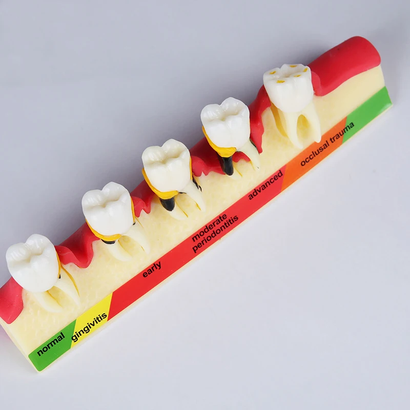 Buy 1 pc Dental Teeth Model for Periodontal Diseases' Assorting & Pathology