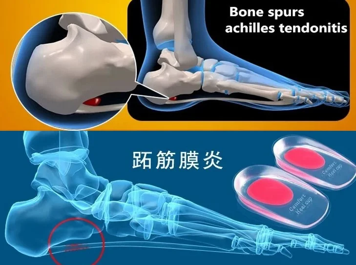 heel cups for bone spurs