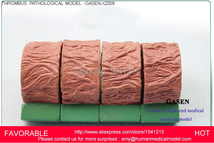 atherosclerosis-with-vascular-thrombosis-process-model-thrombosis-model